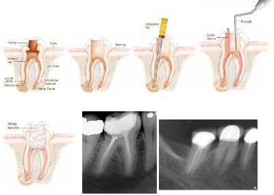 Root Canal brookfield ct