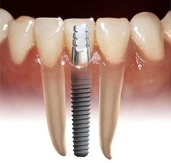 Implantology | New England Dental